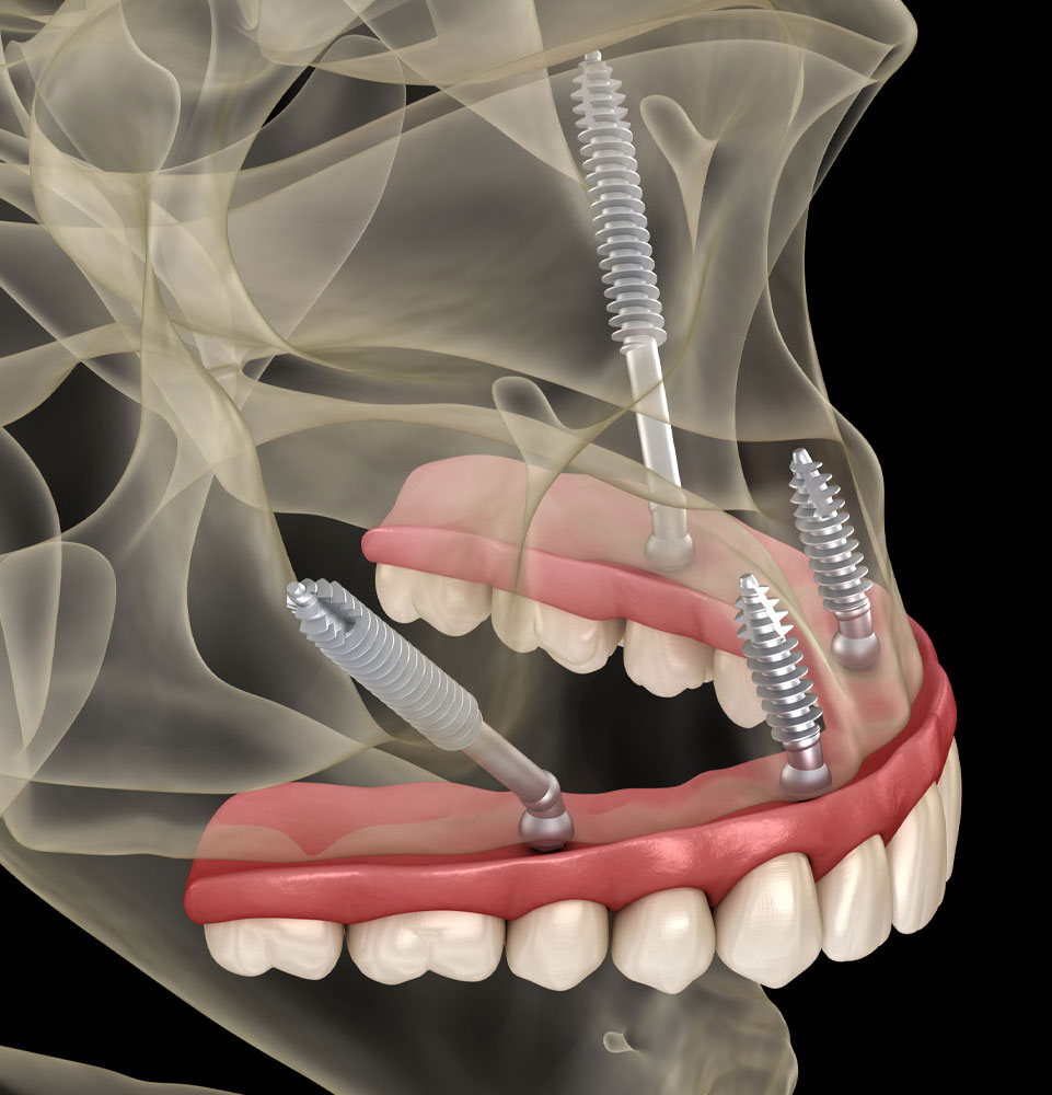 zygomatic 3d medically accurate graphic flip