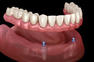 implant dentistry charlotte