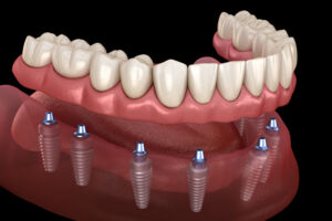tooth implant charlotte