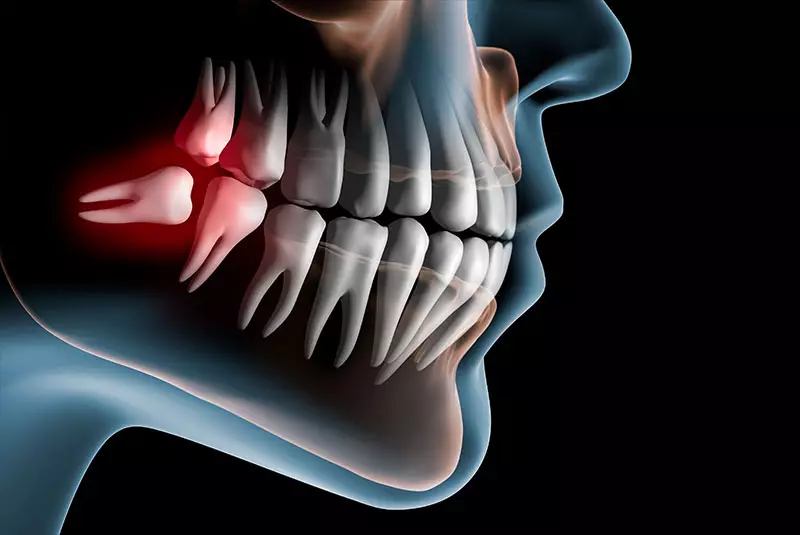 Wisdom Tooth Surgery Charlotte